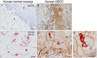 Monocarboxylate Transporter 4 (MCT4) Knockout Mice Have Attenuated <mark class="highlighted">4NQO</mark> Induced Carcinogenesis; A Role for MCT4 in Driving Oral Squamous Cell Cancer